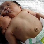 Nace bebé con dos cabezas en China