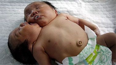 Nace bebé con dos cabezas en China